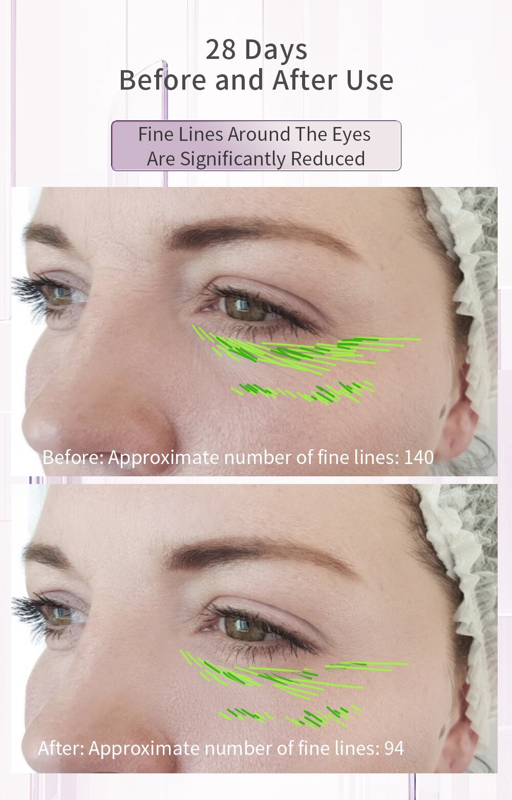 Radiofrequency Face Lifting Beauty Device